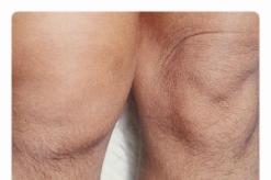 Sinovitis proliferativa de la articulación de la rodilla.