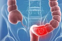 Kanker usus - tanda, gejala pada tahap awal, pengobatan dan prognosis